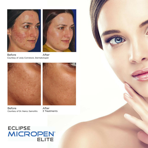 Micro Needling