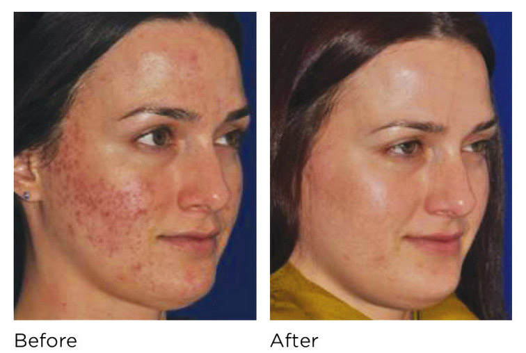 microneedling ogden